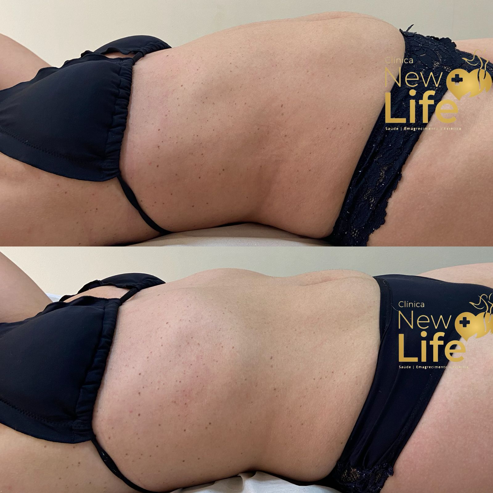 Antes e depois — paciente New Life