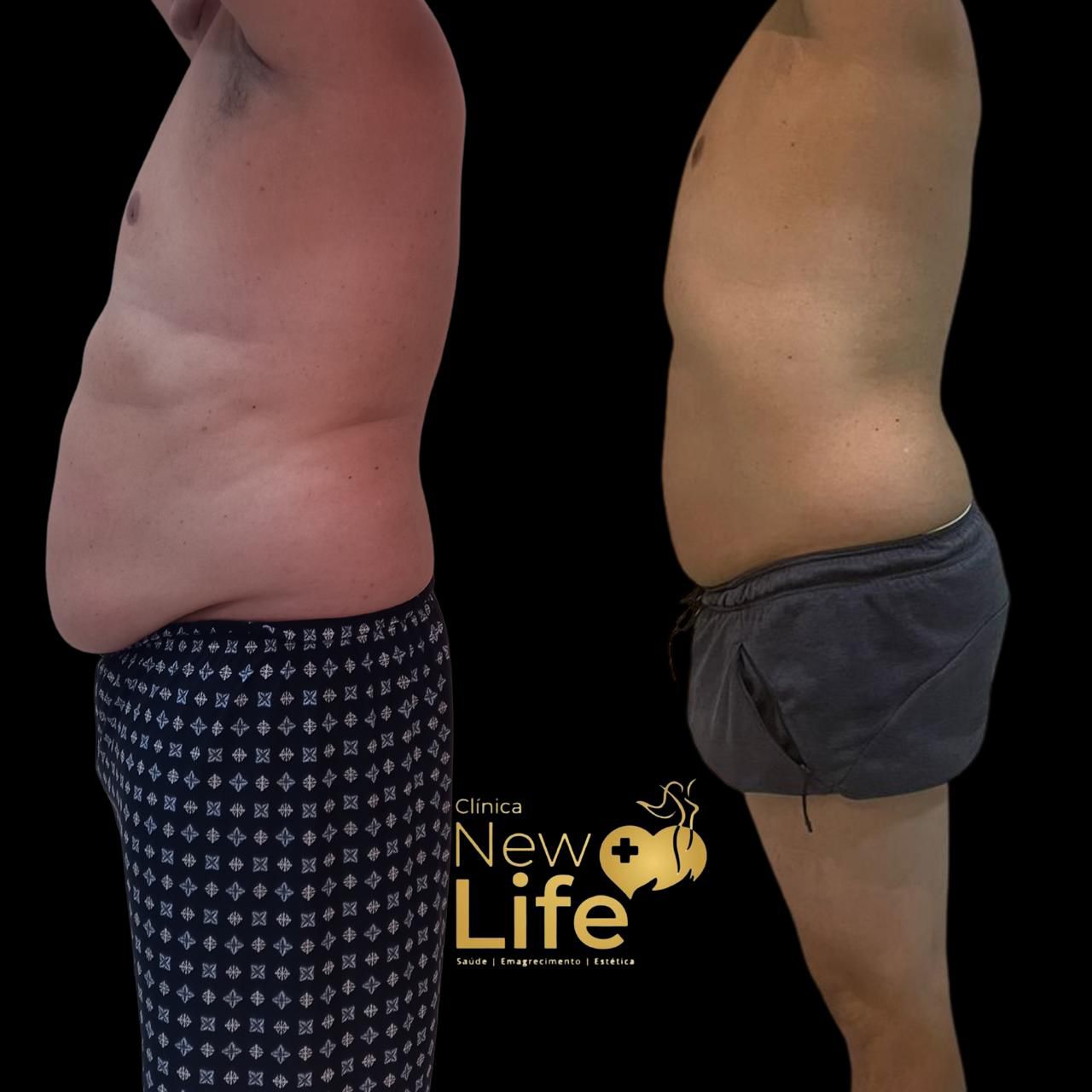 Antes e depois — paciente New Life